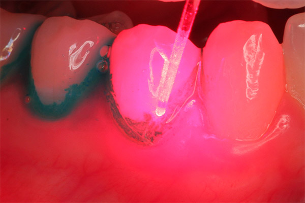 future of periodontal therapy